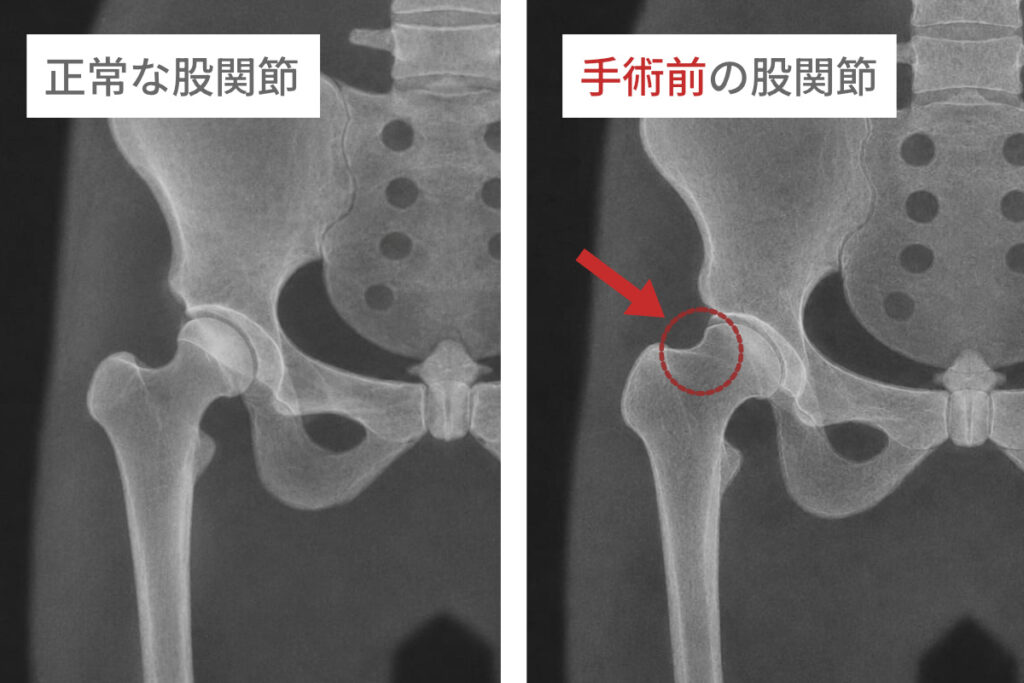 正常な股関節と手術前の股関節の比較