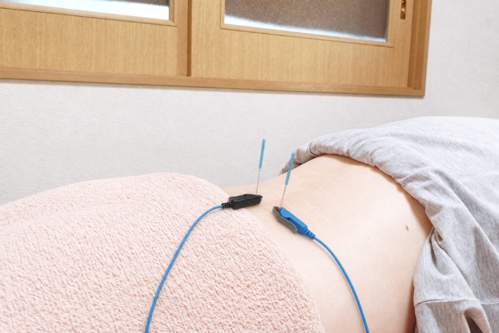 腰への鍼通電施術の様子